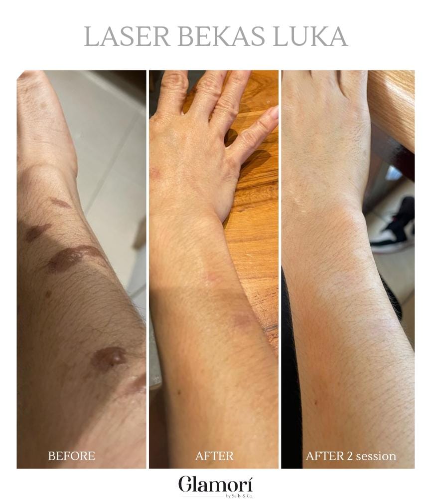 Body Treatment (Body Brightening)