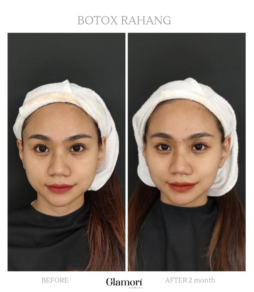 Botox Rahang