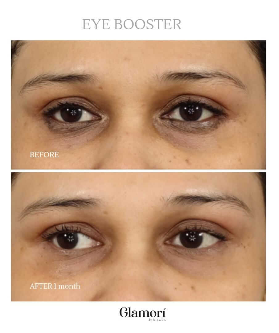 Eyes Treatment