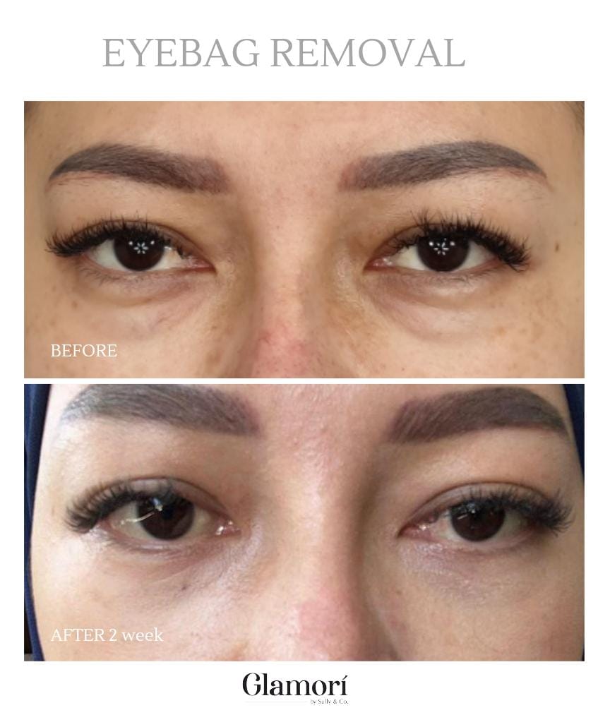 Eyes Treatment