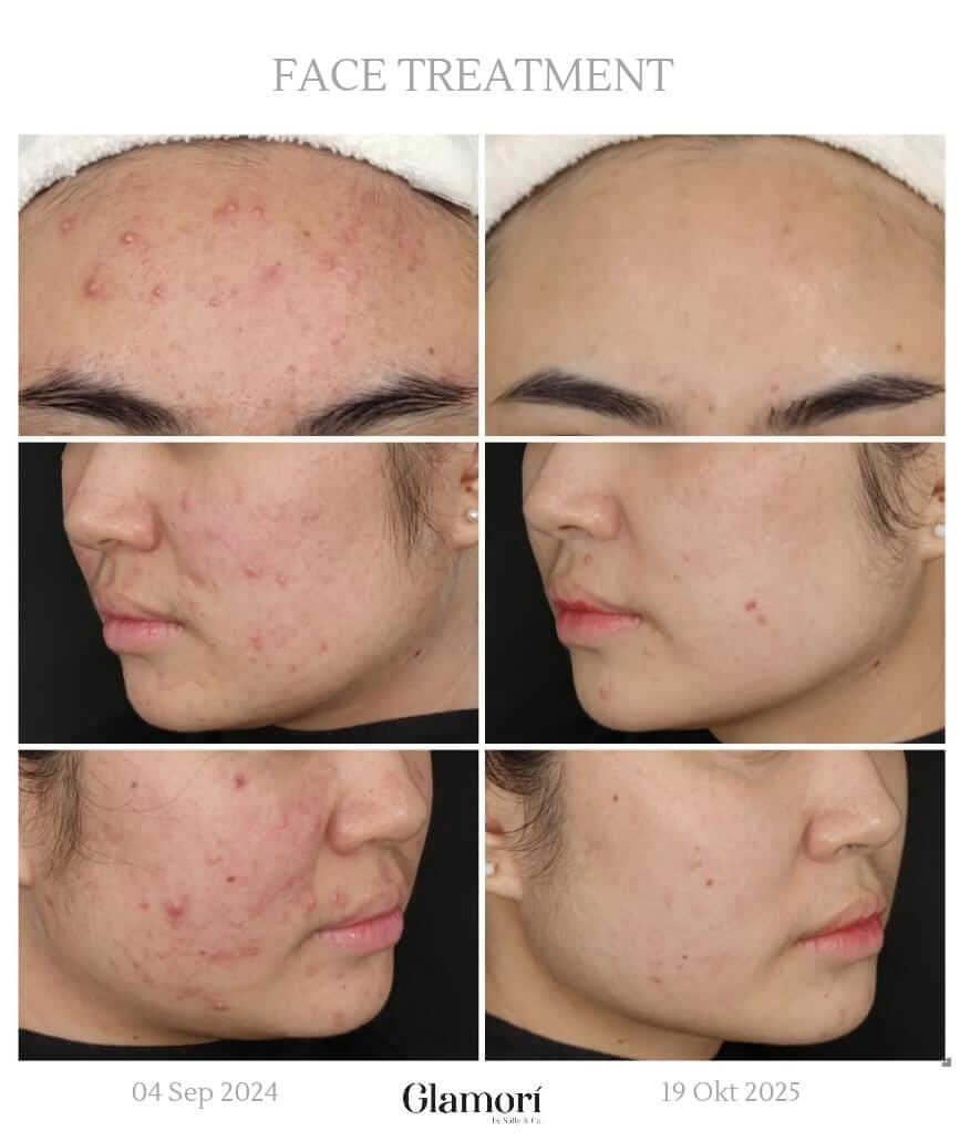 Facial Treatment