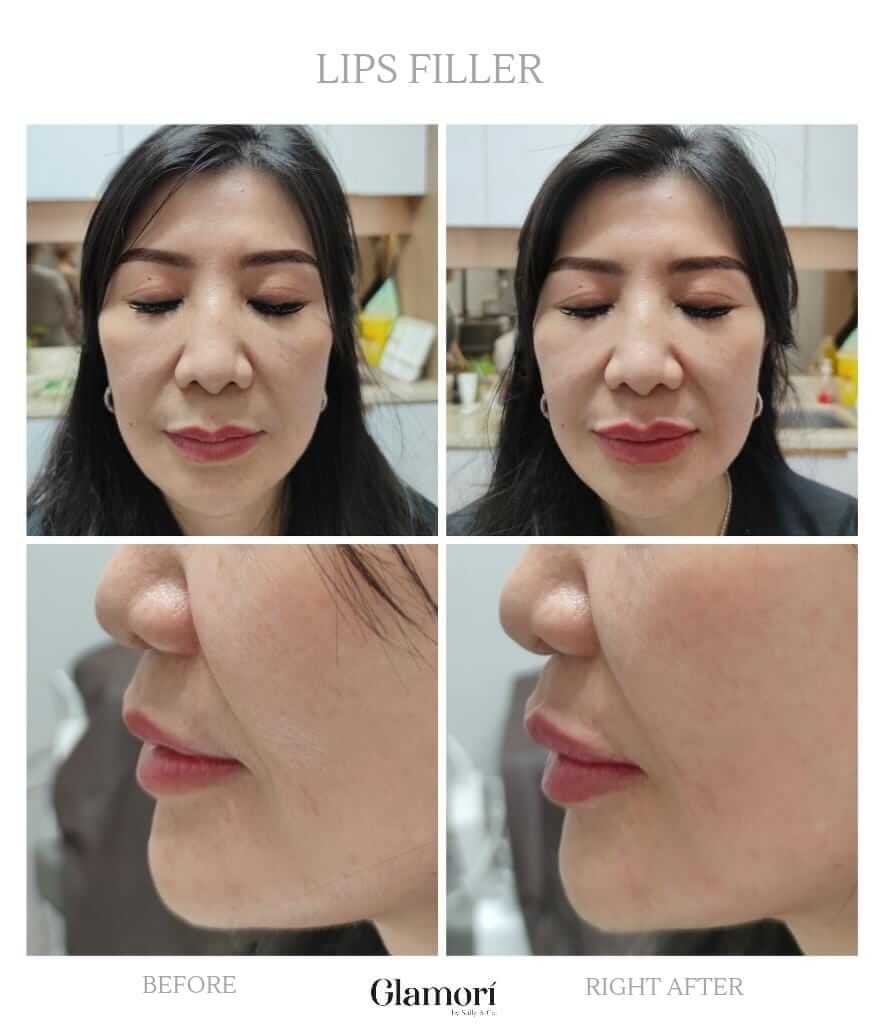 Lips Treatment