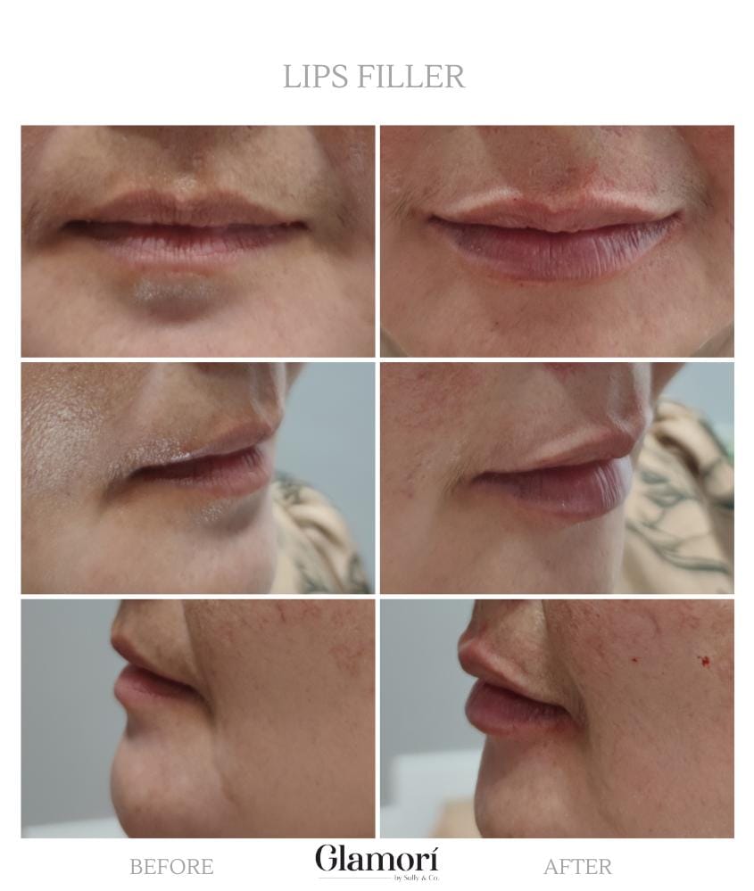 Lips Treatment