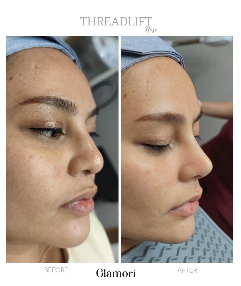 Threadlift Nose